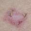 28. Basal Cell Carcinoma Pictures