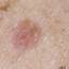 3. Basal Cell Carcinoma Pictures