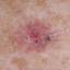 30. Basal Cell Carcinoma Pictures
