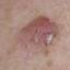 32. Basal Cell Carcinoma Pictures