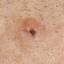 33. Basal Cell Carcinoma Pictures