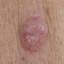 34. Basal Cell Carcinoma Pictures