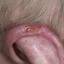 36. Basal Cell Carcinoma Pictures