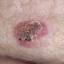 37. Basal Cell Carcinoma Pictures