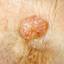 38. Basal Cell Carcinoma Pictures