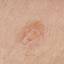 4. Basal Cell Carcinoma Pictures