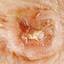 43. Basal Cell Carcinoma Pictures