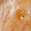 44. Basal Cell Carcinoma Pictures