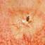 45. Basal Cell Carcinoma Pictures