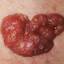 46. Basal Cell Carcinoma Pictures