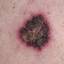 51. Basal Cell Carcinoma Pictures
