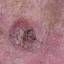 52. Basal Cell Carcinoma Pictures