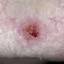 53. Basal Cell Carcinoma Pictures
