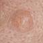 54. Basal Cell Carcinoma Pictures