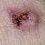 6. Basal Cell Carcinoma Pictures