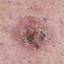 7. Basal Cell Carcinoma Pictures