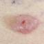 9. Basal Cell Carcinoma Pictures