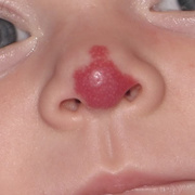 Hemangioma in Nose