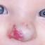 14. Hemangioma in Nose Pictures