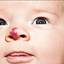 2. Hemangioma in Nose Pictures