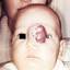 21. Hemangioma in Nose Pictures