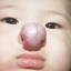24. Hemangioma in Nose Pictures