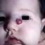 28. Hemangioma in Nose Pictures