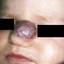 4. Hemangioma in Nose Pictures