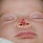 7. Hemangioma in Nose Pictures