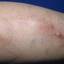 10. Phlebitis Early Stages Pictures