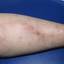 11. Phlebitis Early Stages Pictures