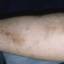 13. Phlebitis Early Stages Pictures