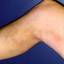 2. Phlebitis Early Stages Pictures