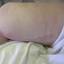 4. Phlebitis Early Stages Pictures