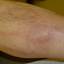 6. Phlebitis Early Stages Pictures