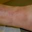 7. Phlebitis Early Stages Pictures