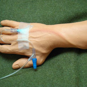 Phlebitis Hand Veins