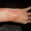 3. Phlebitis Hand Veins Pictures