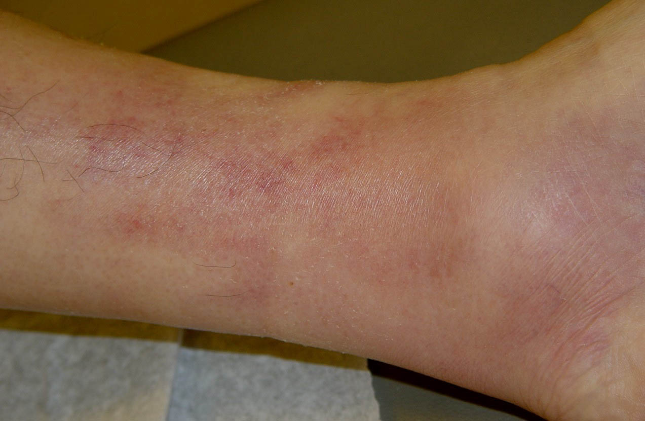 Superficial Phlebitis Pictures 15 Photos And Images