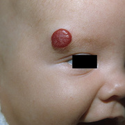 Infant Hemangioma