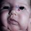 41. Infant Hemangioma Pictures