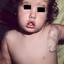 48. Infant Hemangioma Pictures