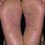 135. Simple Dermatitis Pictures