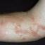 155. Simple Dermatitis Pictures