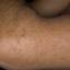 72. Simple Dermatitis Pictures