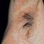 10. Contact Dermatitis in Adults Pictures
