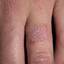 112. Contact Dermatitis in Adults Pictures