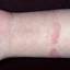 117. Contact Dermatitis in Adults Pictures