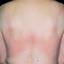 123. Contact Dermatitis in Adults Pictures