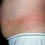 125. Contact Dermatitis in Adults Pictures